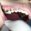 What Are the Special Considerations for Children with Braces at the Pediatric Dentist?