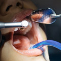 Why Should You Consider Dental Implants For Your Child? Insights From Round Rock Pediatric Dentists