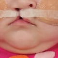 Caring for Children with Cleft Lip and Palate: A Pediatric Dentist's Perspective