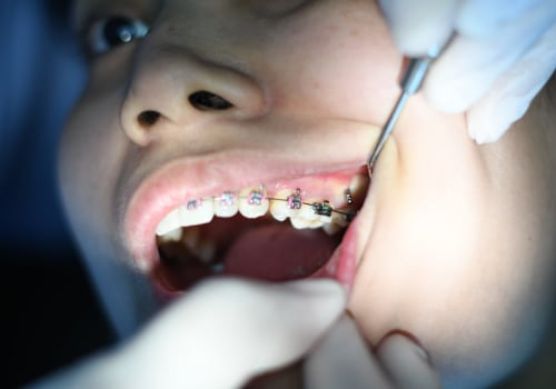What Are the Special Considerations for Children with Braces at the Pediatric Dentist?