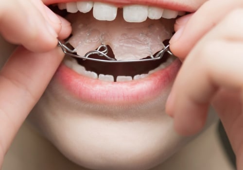 Do Pediatric Dentists Provide Orthodontic Services Such as Braces or Invisalign?